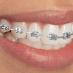 ortodoncia-brackets-dentista-clinica