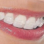 ortodoncia_invisible